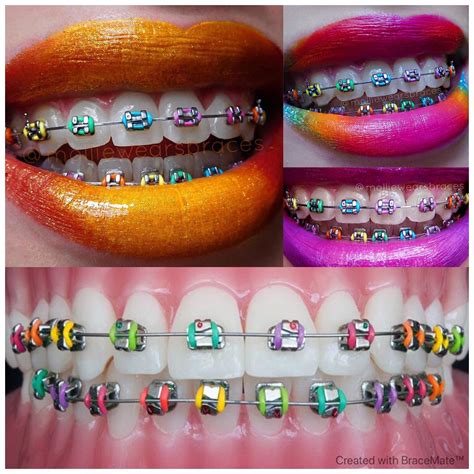 most adorable color for braces.